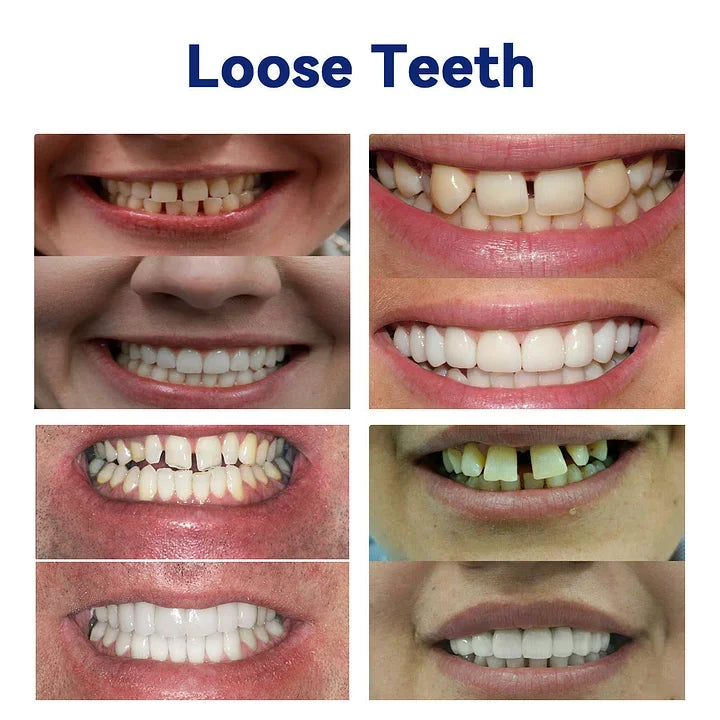 NESLEMYā¢-š¦·Advanced Customized Full Denture Set ā For a Perfect Smile and Natural Comfortš„°( š„Last Day Promotionš„ļ¼