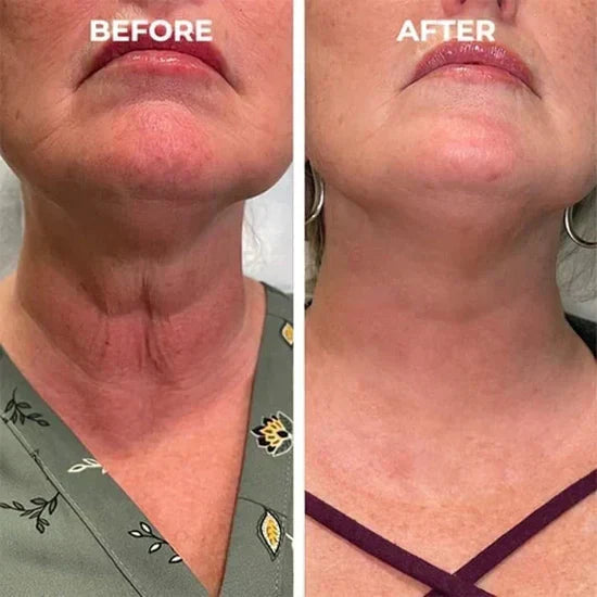 šLast Day Promotionš-Clostridium botulinum Face Serum