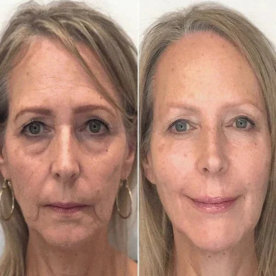 šLast Day Promotionš-Clostridium botulinum Face Serum